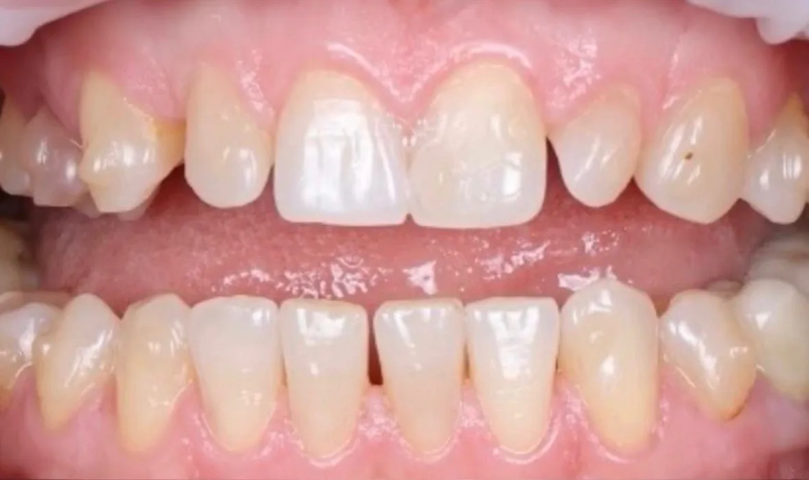 Înainte de tratament — Caz clinic — reabilitare dentară fațete no-prep