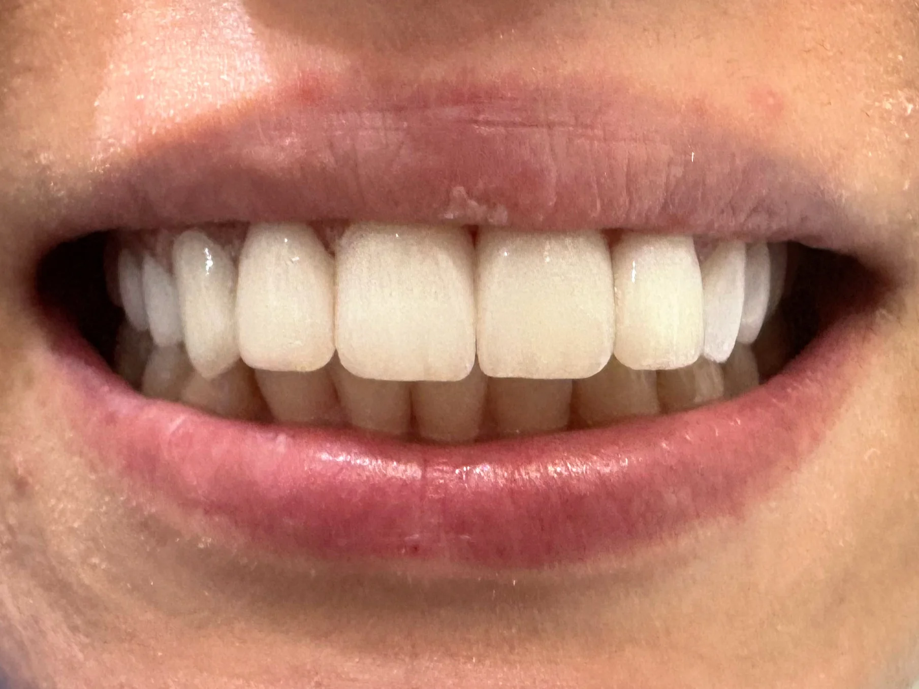 După tratament — Reabilitare dentară