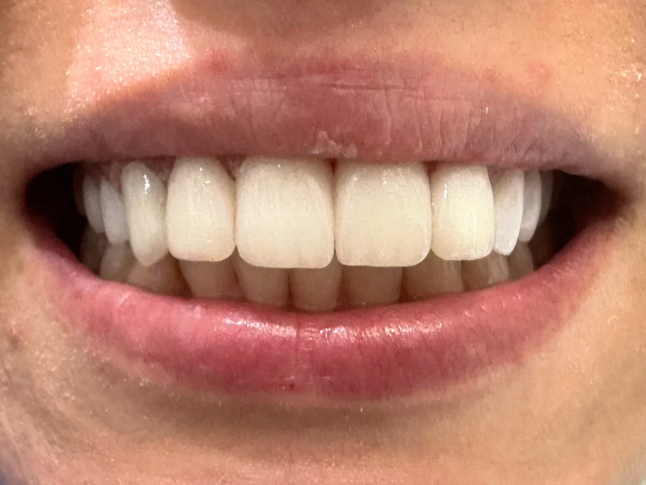 După tratament — Reabilitare dentară