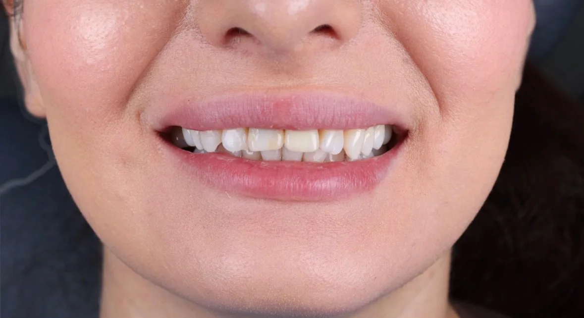 Înainte de tratament — Caz clinic — reabilitare dentară