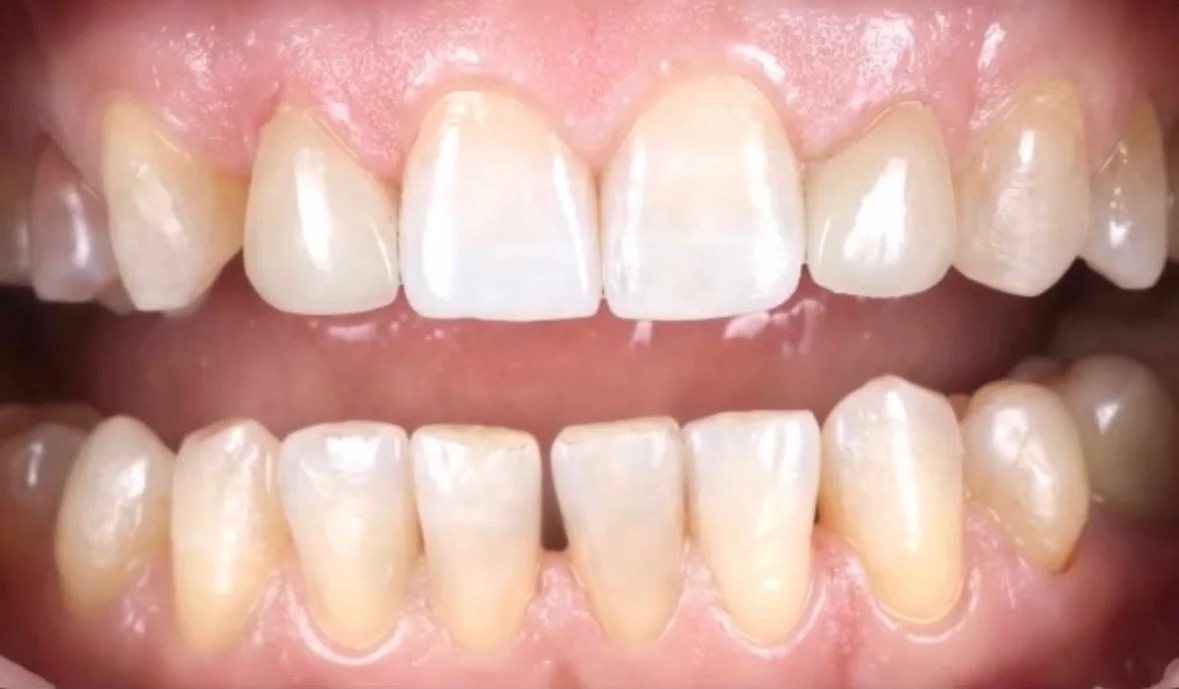 După tratament — Caz clinic — reabilitare dentară fațete no-prep