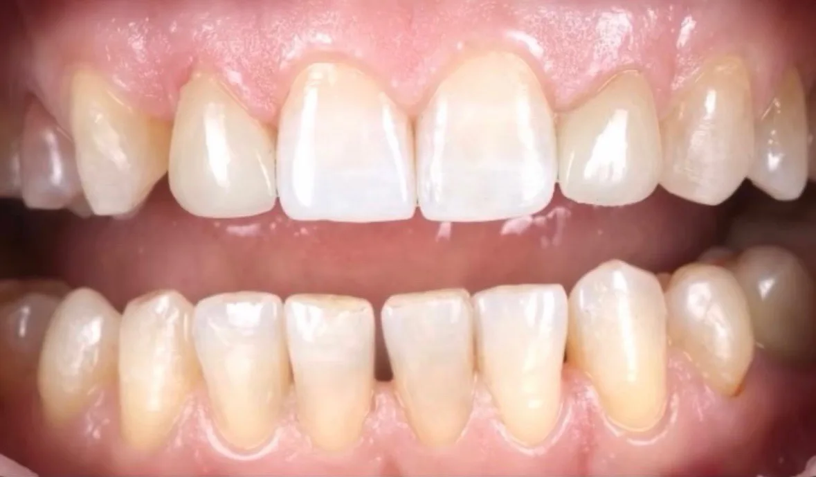 După tratament — Caz clinic — reabilitare dentară fațete no-prep