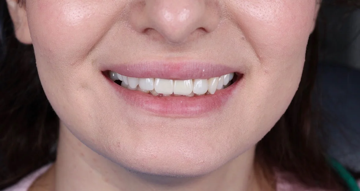 După tratament — Caz clinic — reabilitare dentară