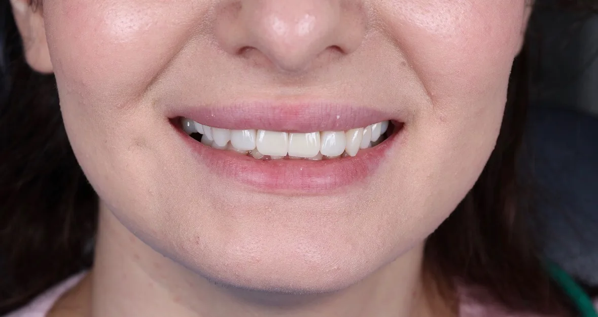 După tratament — Caz clinic — reabilitare dentară