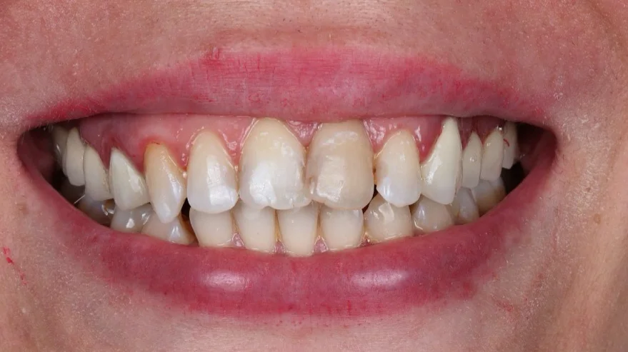 Înainte de tratament — Reabilitare dentară