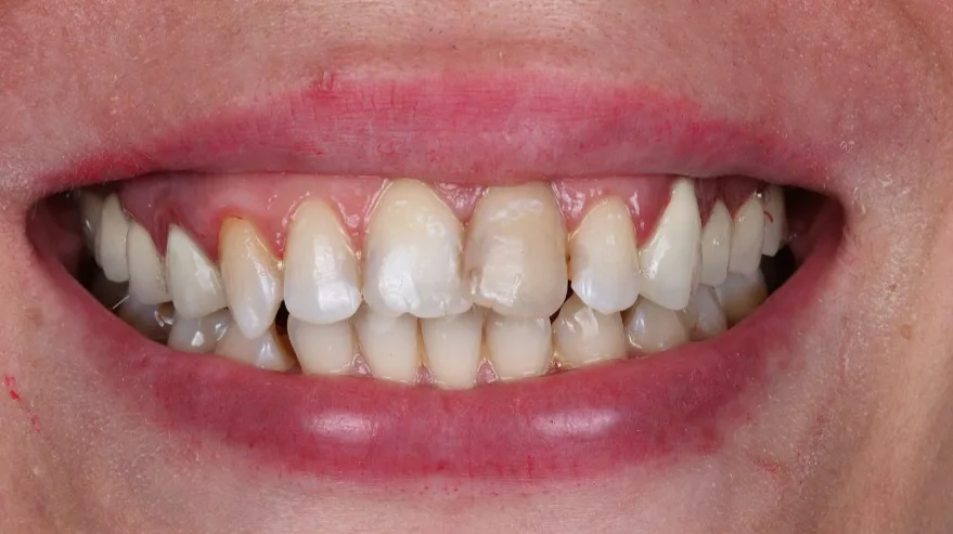 Înainte de tratament — Reabilitare dentară
